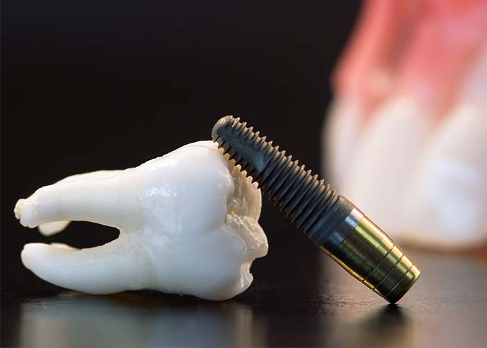 人工植牙