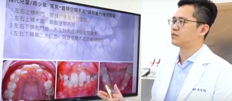 台中隱適美| 牙齒矯正案例- 改善青少年齒顎空間不足