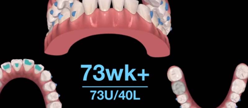 台中隱適美| 矯正案例- 3D定位技術，恢復咬合功能