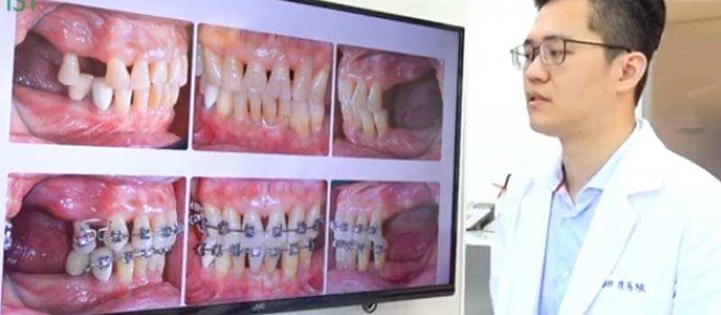 台中隱適美| 矯正案例- 高齡矯正：傳統牙套的限制