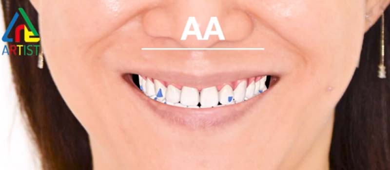 台中隱適美| 矯正案例- 數位矯正評估，療程更快速