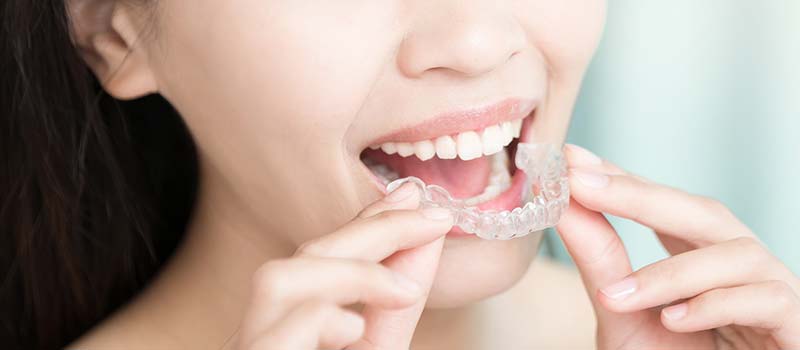 台中隱形矯正|牙齒美容學問大 隱形牙套正夯