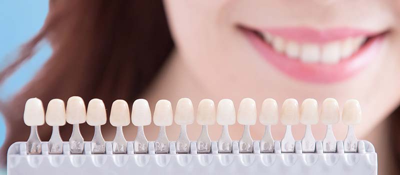 台中美白貼片|告別十年黃板牙 不用美圖修修